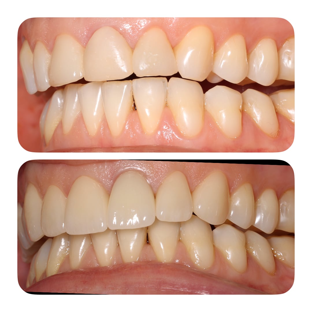 Керамічні коронки/вініри E-max на  6 передніх верхніх зубів. Stomaline Dental Studio 2025