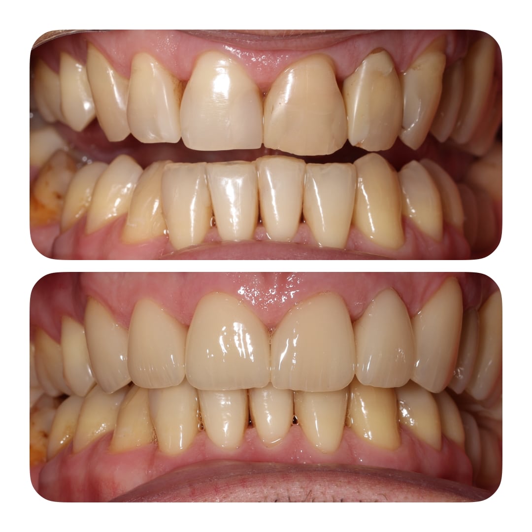 Керамічні коронки/вініри E-max на  6 передніх верхніх зубів. Stomaline Dental Studio 2025
