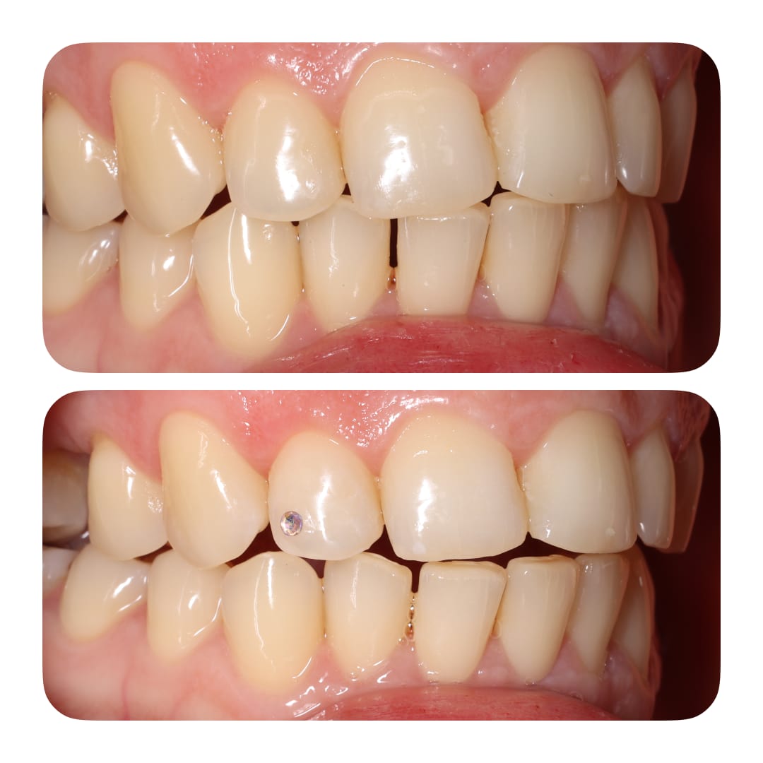 Зубна прикраса, скайс. Stomaline Dental Studio 2025