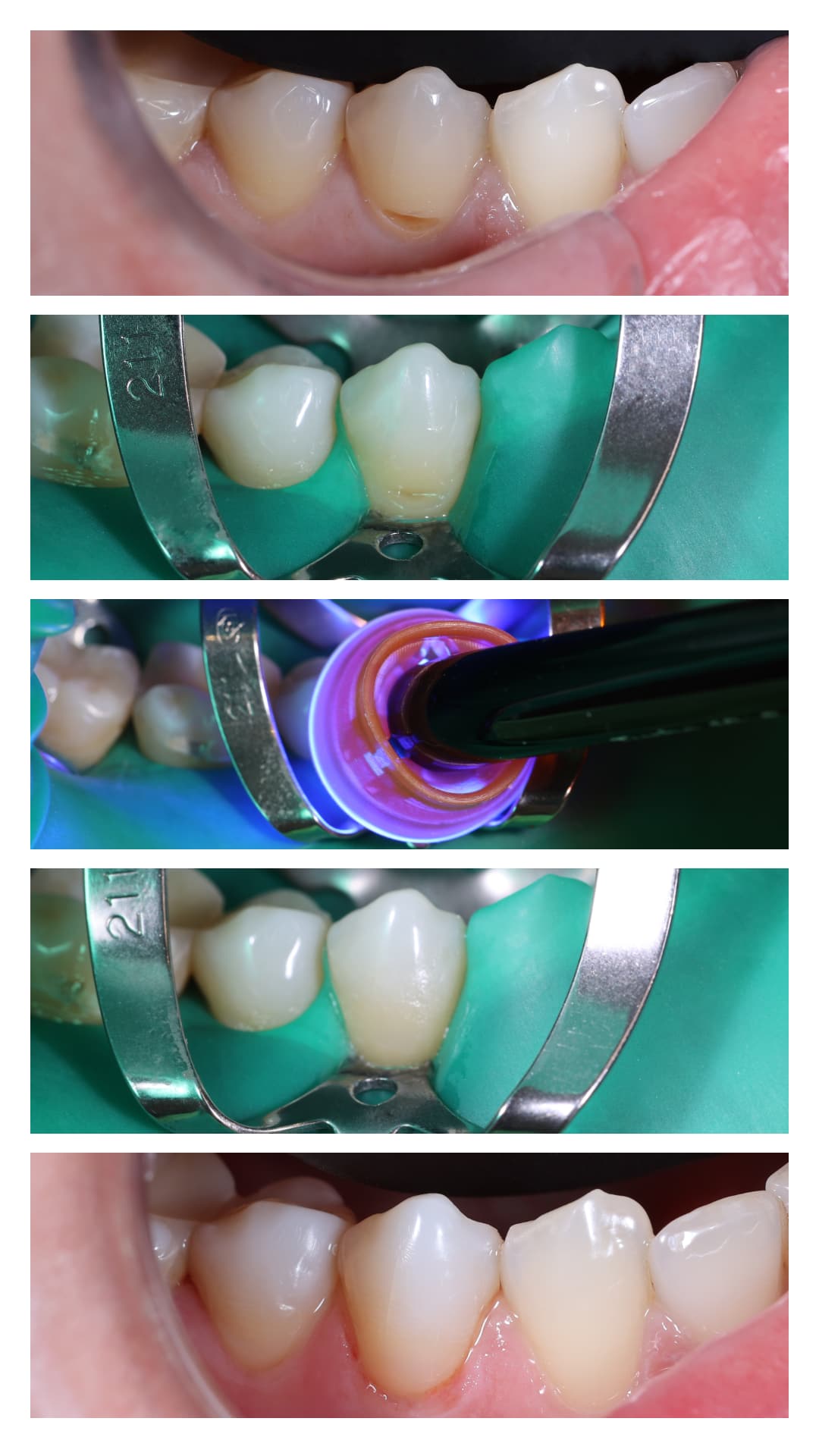 Реставрація клиновидного дефекту нижнього премоляру. Stomaline Dental Studio 2024
