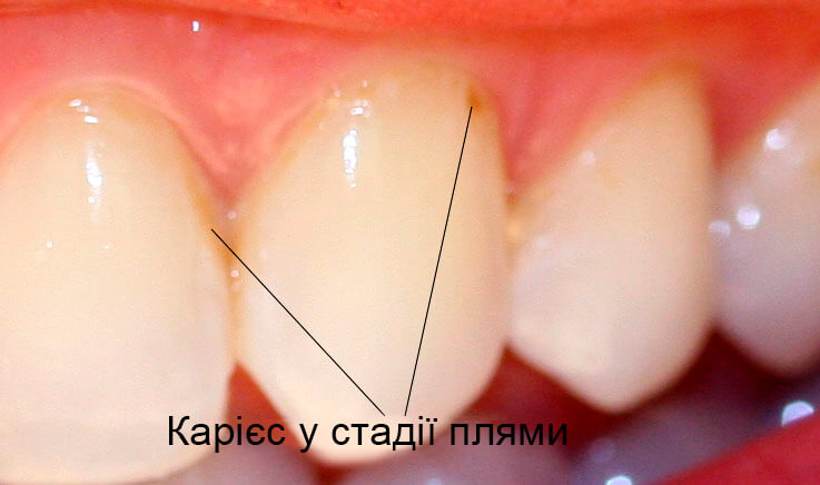 Каріозна пляма