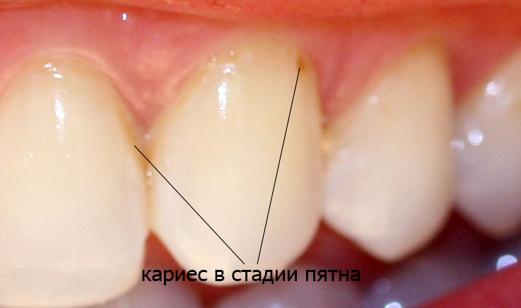 Кариозное пятно