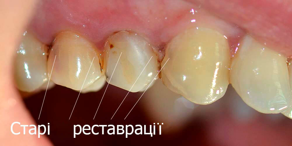 Старі реставрації зубів, які потребують заміни Старі реставрації зубів