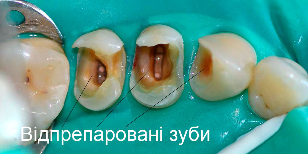 Відпрепаровані зуби, готові до відновлення Відпрепаровані зуби