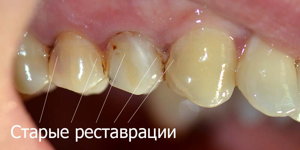 Старые реставрации зубов, нуждающиеся в замене Старые реставрации зубов
