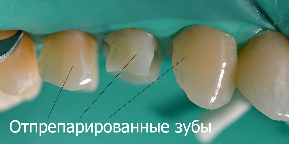 Зубы отпрепарированы, кариес почищен Отпрепарированные зубы