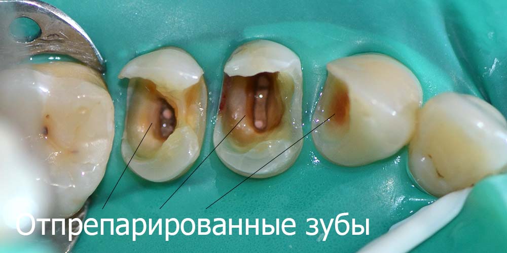 Зубы отпрепарированы, кариес почищен Отпрепарированные зубы