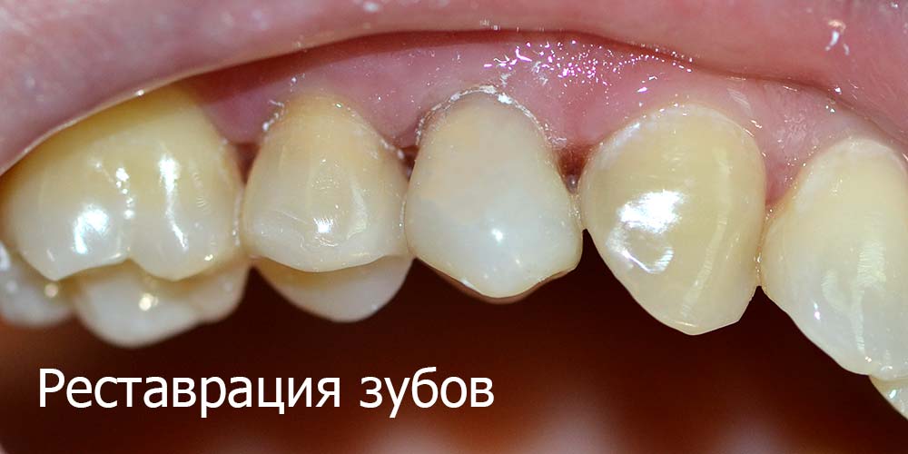 Реставрация зубов Реставрация зубов
