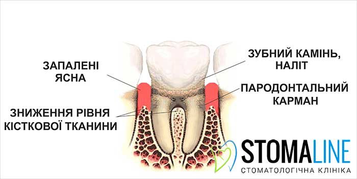 Пародонтит: запалення ясен і втрата кісткової тканини навколо зуба
