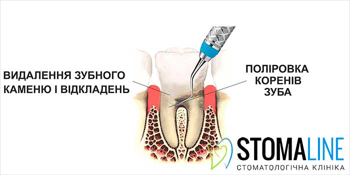 Лікування пародонтиту. Проведення закритого кюретажу ясен, робота кюретами Грейсі Закритий кюретаж ясен